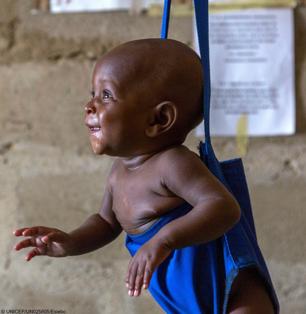 Baby Falmata, 6 months, is being treated for malnutrition in #Nigeria. …