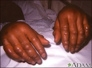 Cold weather can put your body at risk. Learn about preventing frostbite and hyp…